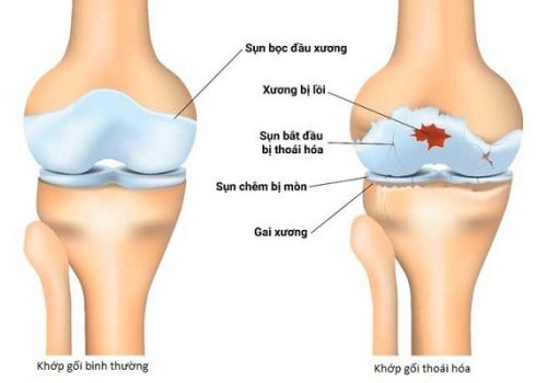 Những thói quen làm bạn dễ thoái hóa xương khớp sớm 