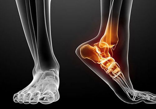 Thoái hóa khớp cổ chân do đâu?