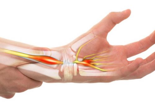 Đau nhức, tê bì chân tay do hội chứng ống cổ tay