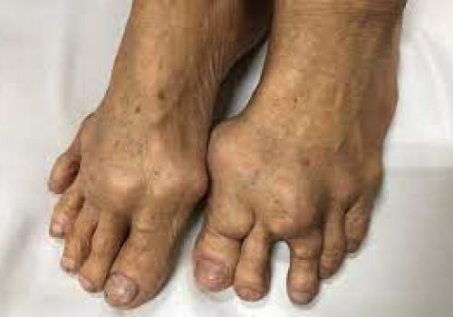 Bệnh gút (gout) và những điều cần biết