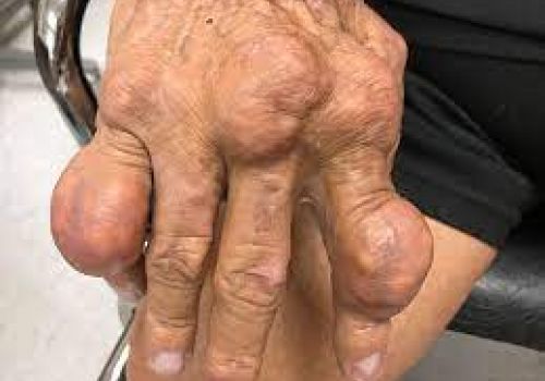 NGUYÊN NHÂN, TRIỆU CHỨNG VÀ ĐIỀU TRỊ HẠT TOPHI (NỐT TOPHI)