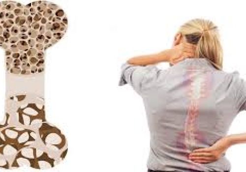 Tạm biệt loãng xương với 5 loại thảo dược quý