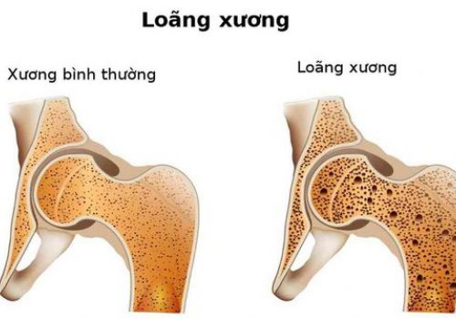 Loãng xương: 8 nhóm yếu tố nguy cơ bạn cần biết