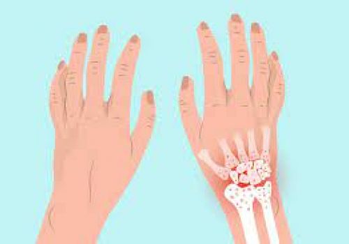 NGUYÊN NHÂN, TRIỆU CHỨNG VÀ CÁCH ĐIỀU TRỊ THOÁI HÓA KHỚP CỔ TAY