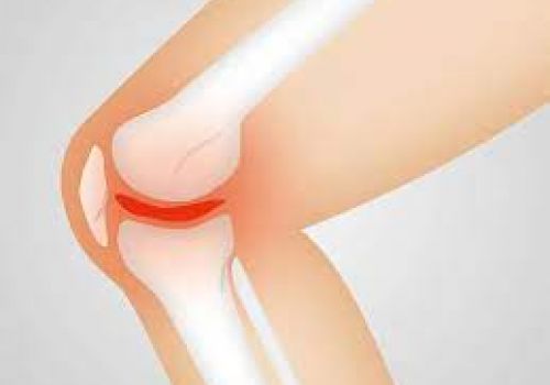 Giải pháp phòng ngừa tổn thương sụn khớp