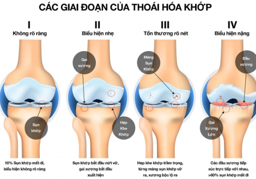 Sự thoái hóa của khớp diễn ra như thế nào?