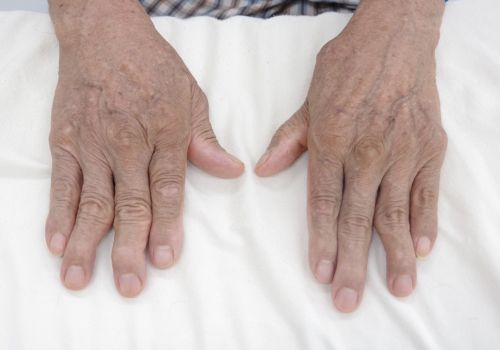 Các triệu chứng thường thấy của bệnh viêm khớp dạng thấp