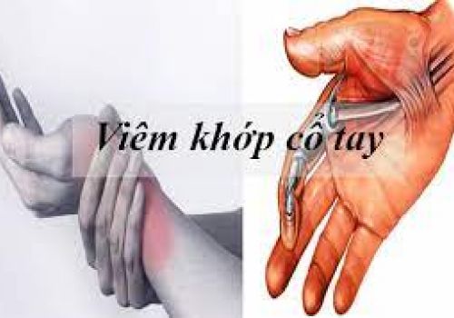 TRIỆU CHỨNG, NGUYÊN NHÂN VÀ CÁCH PHÒNG TRỊ BỆNH VIÊM KHỚP CỔ TAY