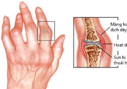 Viêm khớp bàn tay