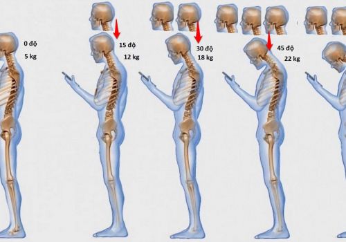 CẢNH BÁO NHỮNG TÁC HẠI NGUY HIỂM CỦA SMARTPHONE ĐỐI VỚI XƯƠNG KHỚP