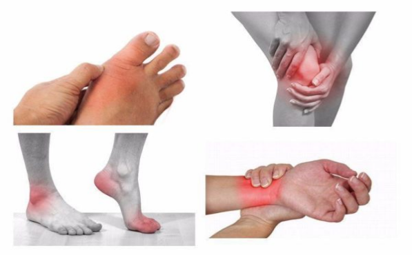 Nibifa tê bì chân tay