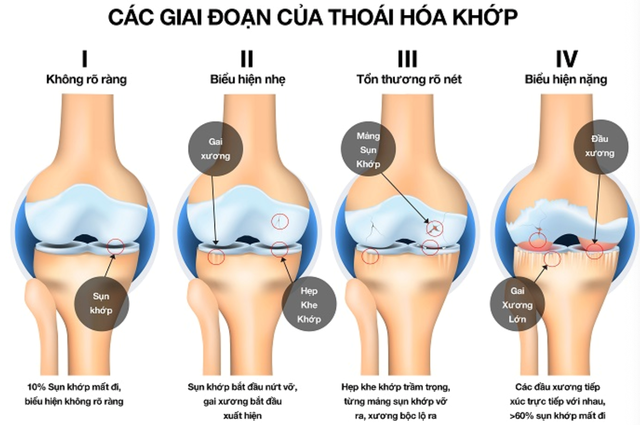 thoái hoá xương