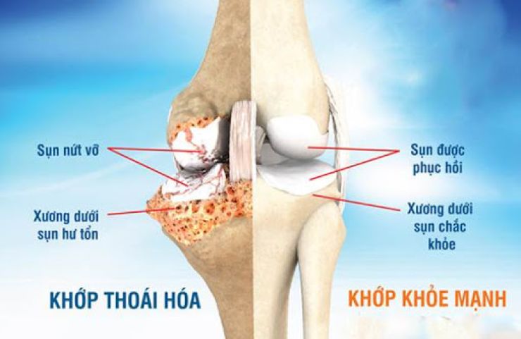 thoai-hoa-khop_1